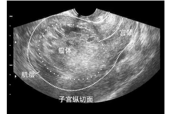 子宫子宫肌瘤的呈像