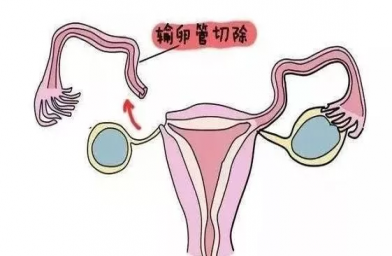 广西慈铭博鳌国际医院三代试管婴儿，切除双侧输卵管还能做试管婴儿吗？
